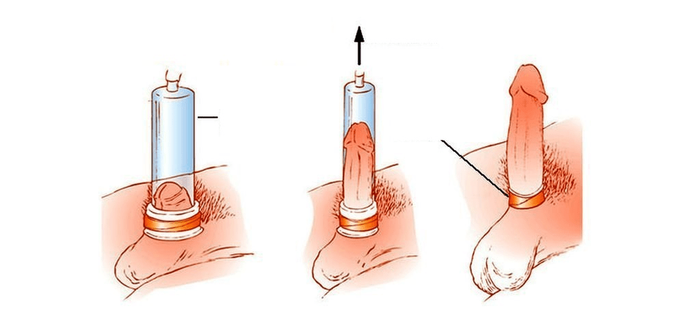 The working principle of the vacuum pump for penis enlargement
