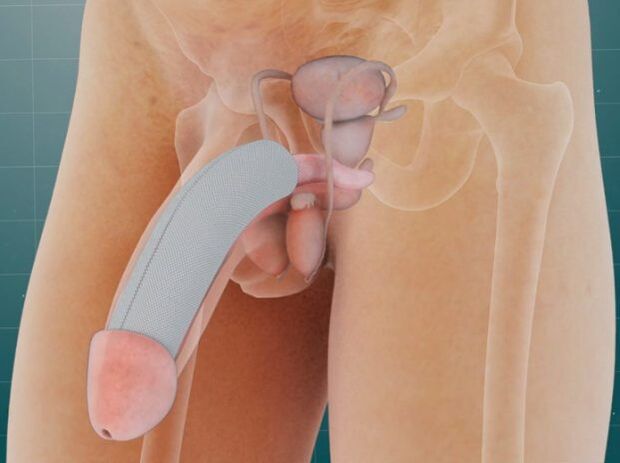 The penis after a special implant is implanted under the skin
