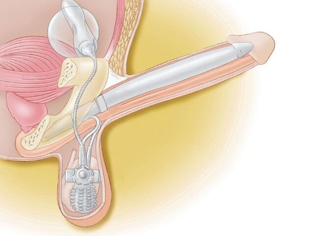 penile prosthesis enlargement