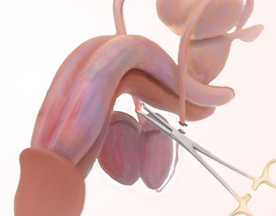 Ligamentotomy for Penile Enlargement